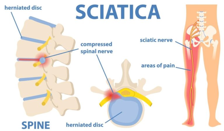 Escape the agony: Discover sciatica relief in under 8 minutes