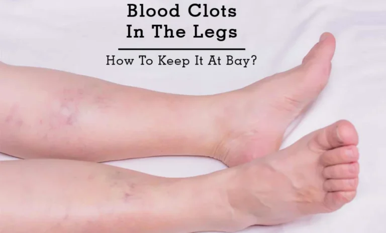 Understanding the Hidden Dangers: Pictures of Blood Clot in Leg