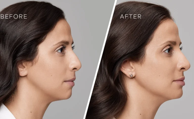 Enhance Your Facial Profile: All You Need to Know About Chin Filler