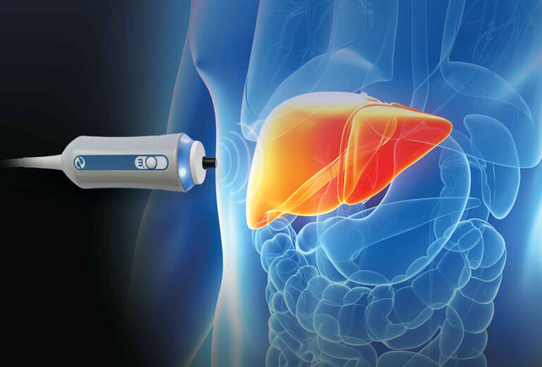 Is Fibroscan the Future of Liver Biopsy? An In-Depth Analysis