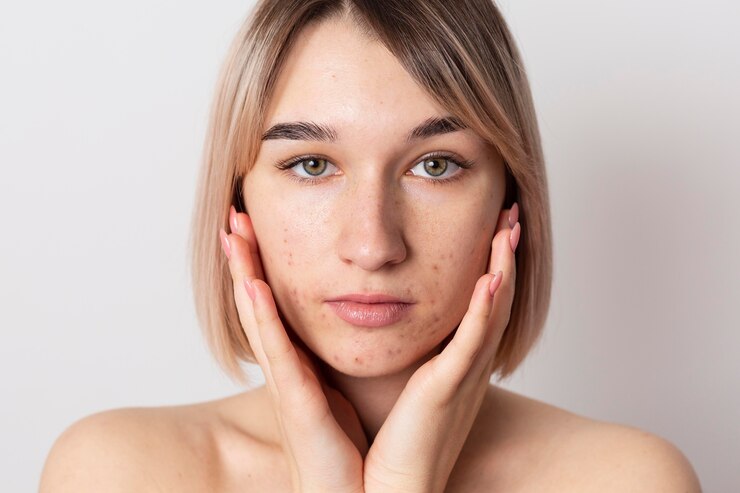 Clindanol vs. Other Acne Medications: Which One Works Best?