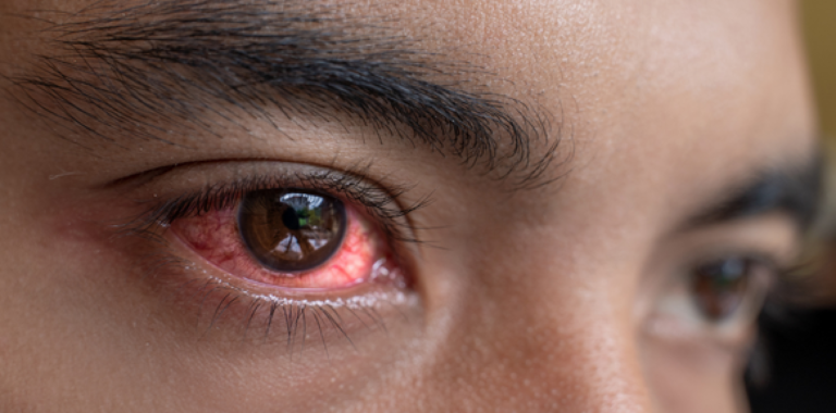 what is commonly misdiagnosed as pink eye