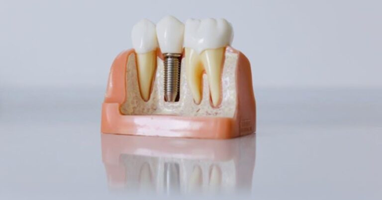 all on four dental implants