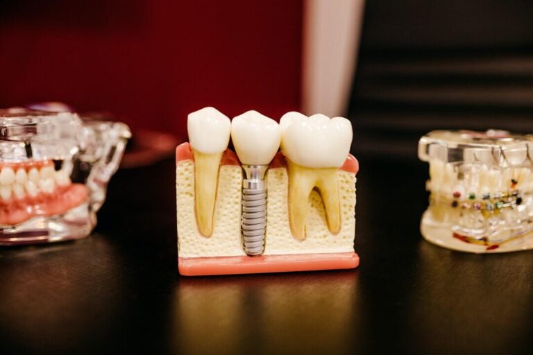 The Importance of Proper Care and Maintenance for Full Mouth Dental Implants
