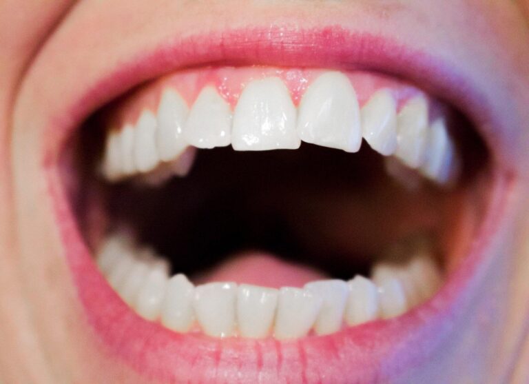 Are Large Gums a Cause for Concern? When to Seek Professional Help and Treatment
