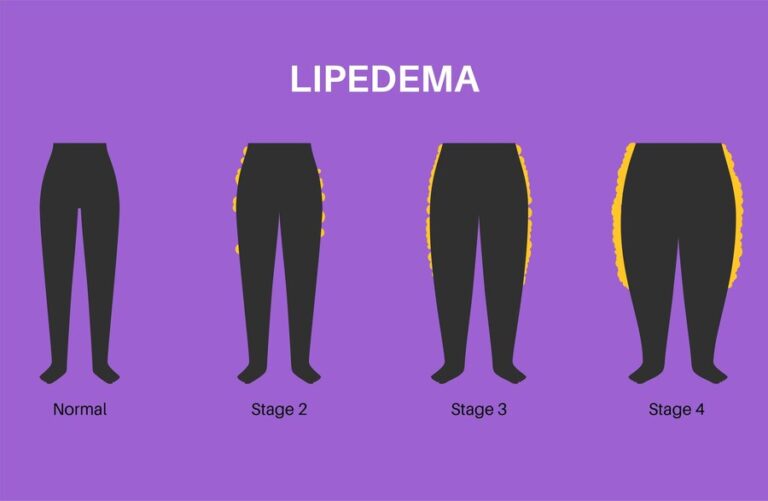 Lipedema