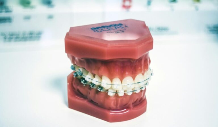 Metal vs Ceramic Braces